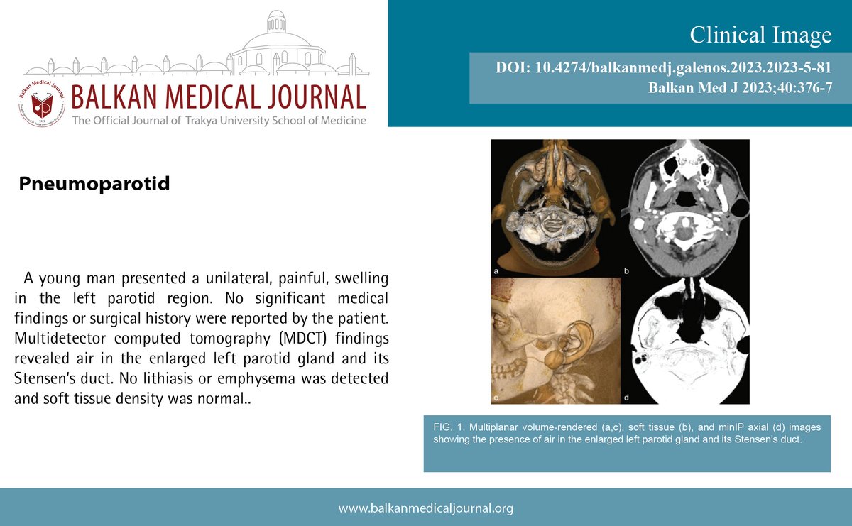 Pneumoparotid
You can see the free full text of the research by Ana Stankovic et al.
Link : balkanmedicaljournal.org/uploads/pdf/pd…