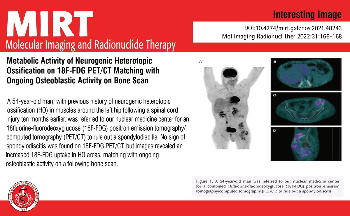 MIRTOfficial's tweet image. Metabolic Activity of Neurogenic Heterotopic Ossification on 18F-FDG PET/CT Matching with Ongoing Osteoblastic Activity on Bone Scan
You can see the free full text of the research by Matthieu Dietz et al.
Link : mirt.tsnmjournals.org/articles/metab…
#Heterotopic #ossification #bonescan