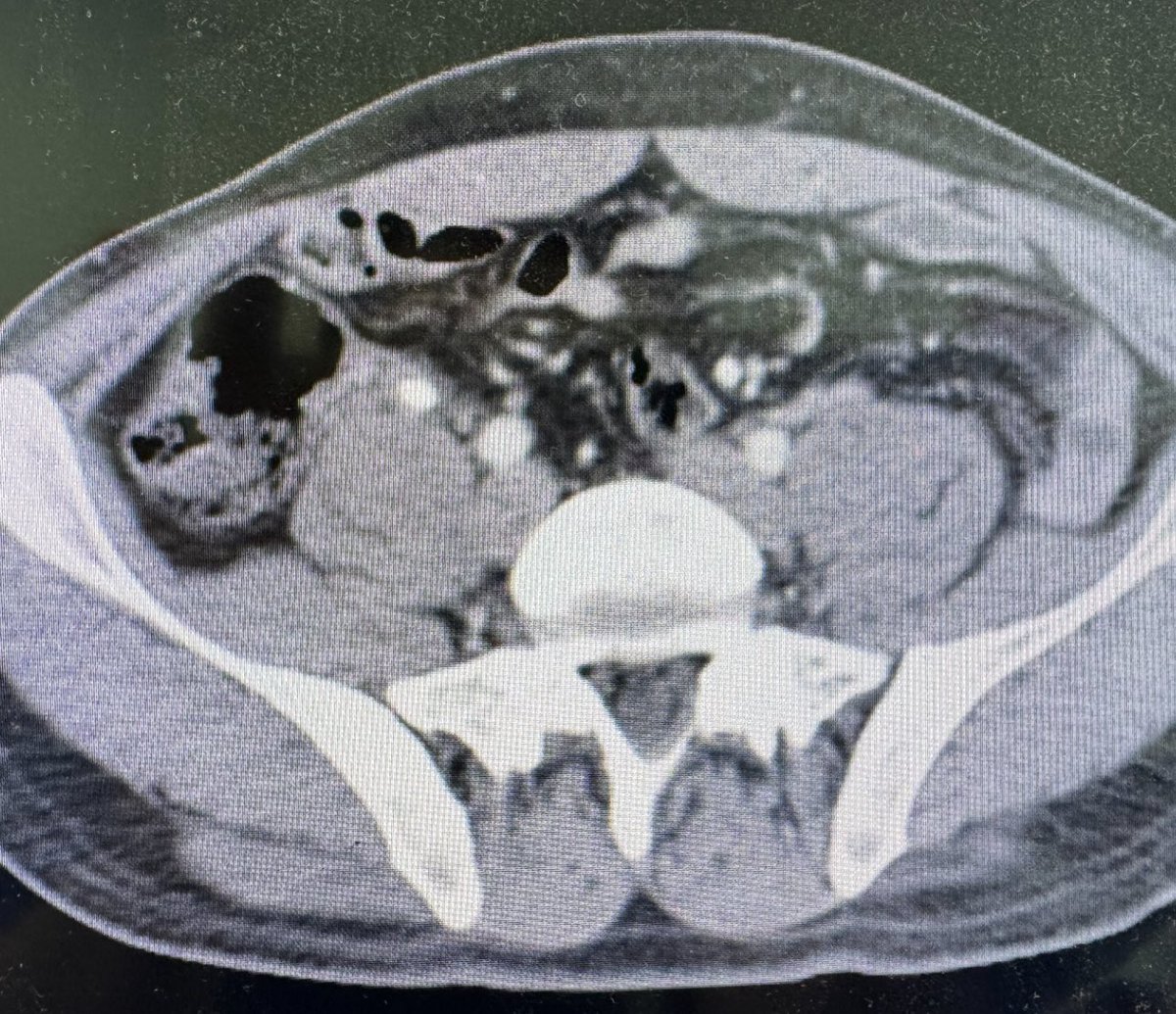 Stump appendicitis:
(not mine, came to me😅)