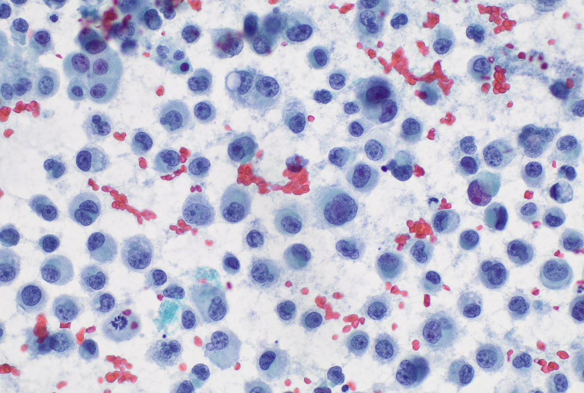 Enhorabuena a Alexandre Rey López, residente de segundo año del Hospital Clínic de Barcelona, por ser el autor de nuestro #CasoDelMes de AGOSTO 2025.

seap.es/actualidad/not…