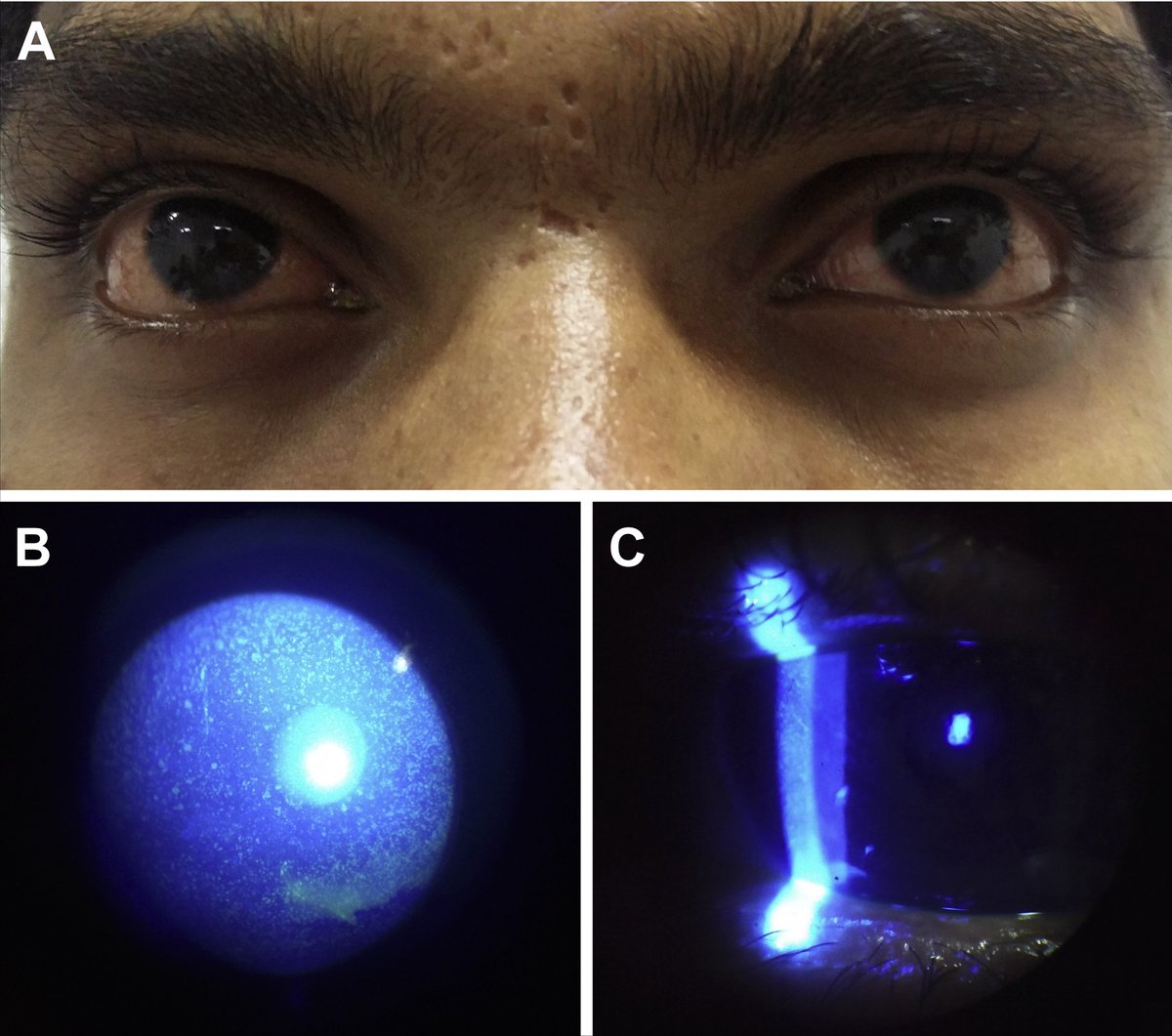 The sun’s rays are more intense in the dry season, especially in open, dusty areas. Risk of photokeratitis, cataract progression, and macular degeneration increases with prolonged UV exposure. Lack of sunglasses or protective headgear worsens the situation.
Take care of your eyes