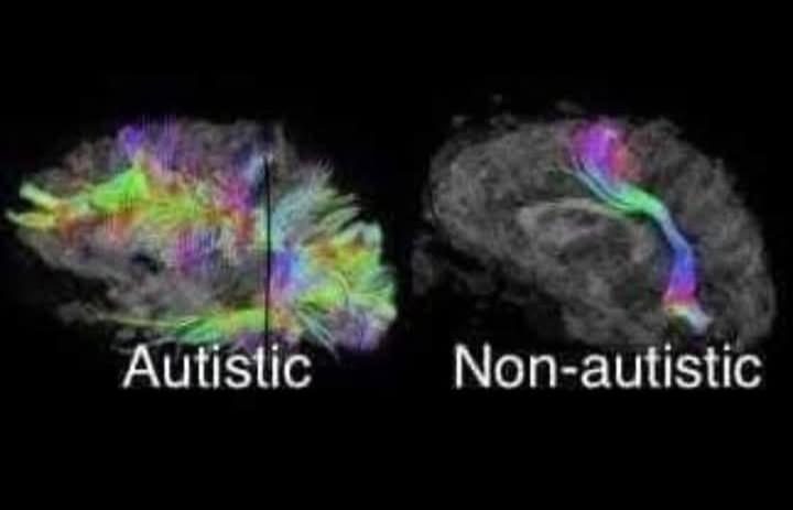 Böyle bir beyinle yaşamanın dayanılmaz ağırlığı...sahibine de,ailesine de...