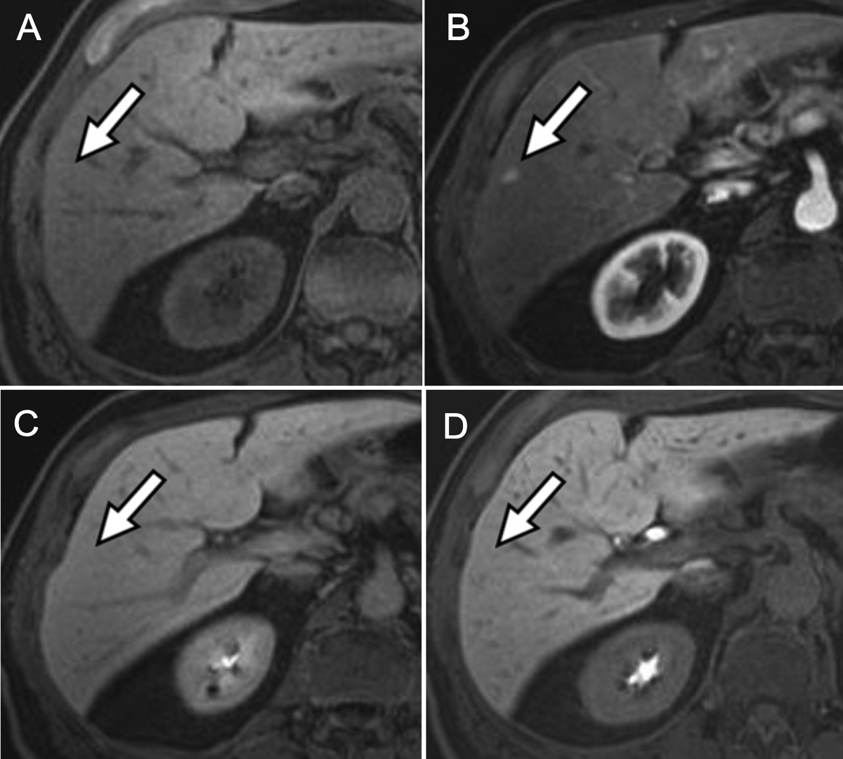 🔍 #TipOfTheDay
💡 HBP iso-intensity as a sign of benignity
🩻 A-B: Focal AP hyperenhancement (arrow) with no pre-contrast abnormality
🩻 C-D: Iso-intensity on HBP → matches background liver

✅ Suggests Arterioportal Shunt 
#RadRes #MedTwitter
