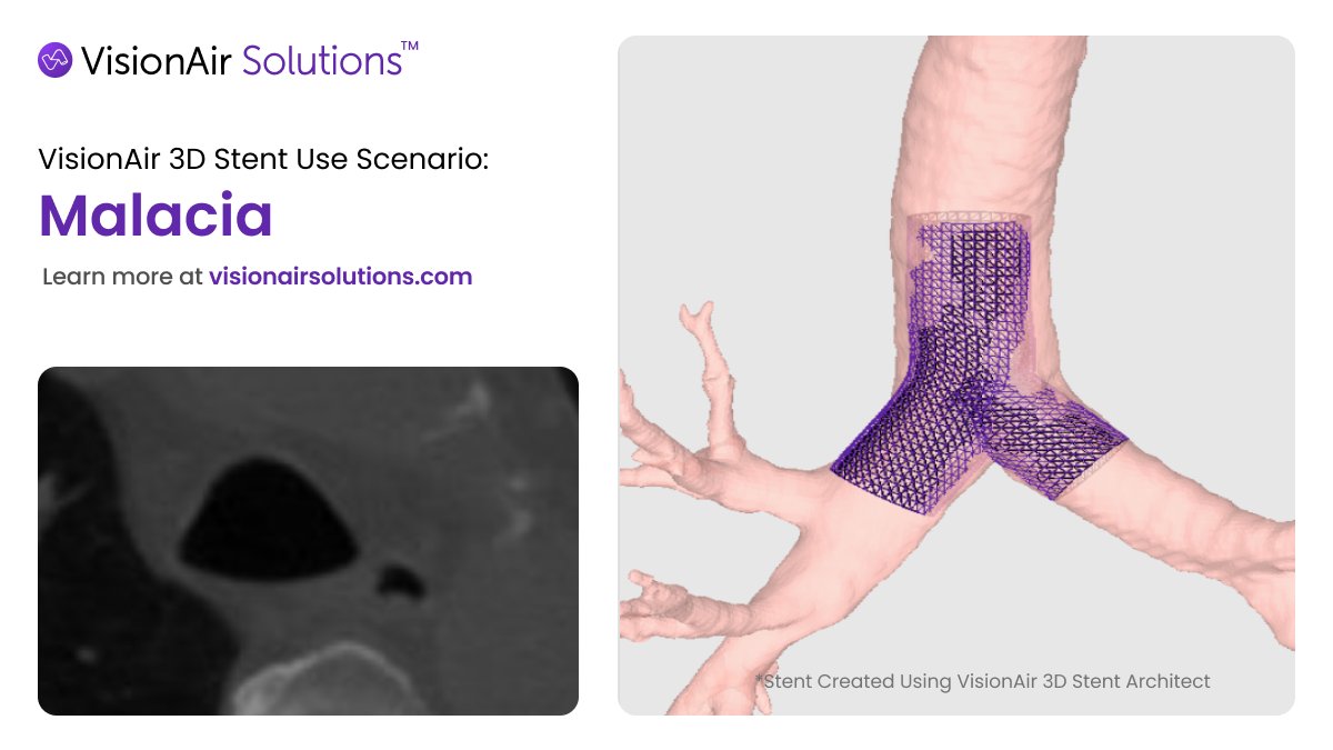 Primary Tracheobronchomalacia is a rare condition where the tracheal/bronchial walls are weak and collapse during breathing, making each breath a struggle.

This patient-specific 3D stent was designed exactly for one such patient providing custom-fit to their anatomy and ensuring