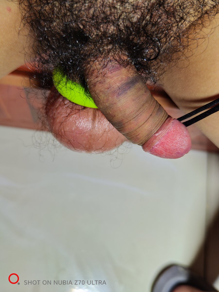 Luoliling's tweet photo. 玩的最大的一次？
先是5个去势圈绑了一个小时
然后是穿刺，用光了所有存货，大概115针
再然后就是注水，带着握力环注射了大概2-300ml
最后打了个蓄谋已久的pa
因为玩了圈也就没用麻药，痛还能忍受，但仍然穿了很久期间还失败了一次
#穿刺 https://t.co/zEZ7BWPMAY