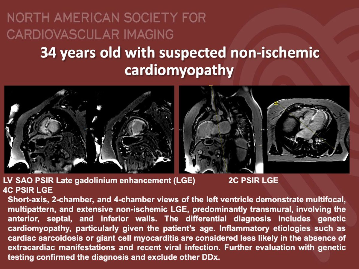 NASCI (@nascisociety) on Twitter photo #NASCI Case Series
Case 85
Courtesy of A. Albriek, M. Alaqaili, R. Alwasiah, A Ramos from University of Ottawa Heart Institute
What is the right answer?
#whyCMR #YesCCT
<a href="/GregKicska/">Gregory Kicska</a> <a href="/JRevRad1/">Jonathan Revels DO, FSAR</a> <a href="/dianalitmano/">diana litmanovich</a> <a href="/DanielVargasMD/">Daniel Vargas, MD</a> <a href="/kirschj/">Jacobo Kirsch, MD, MBA, FACR</a> <a href="/prachipagarwal/">Prachi Agarwal</a> <a href="/EscrOffice/">ESCR Vienna</a> <a href="/CarlottaOnnis/">Carlotta Onnis</a> #NASCI Case Series
Case 85
Courtesy of A. Albriek, M. Alaqaili, R. Alwasiah, A Ramos from University of Ottawa Heart Institute
What is the right answer?
#whyCMR #YesCCT
<a href="/GregKicska/">Gregory Kicska</a> <a href="/JRevRad1/">Jonathan Revels DO, FSAR</a> <a href="/dianalitmano/">diana litmanovich</a> <a href="/DanielVargasMD/">Daniel Vargas, MD</a> <a href="/kirschj/">Jacobo Kirsch, MD, MBA, FACR</a> <a href="/prachipagarwal/">Prachi Agarwal</a> <a href="/EscrOffice/">ESCR Vienna</a> <a href="/CarlottaOnnis/">Carlotta Onnis</a>