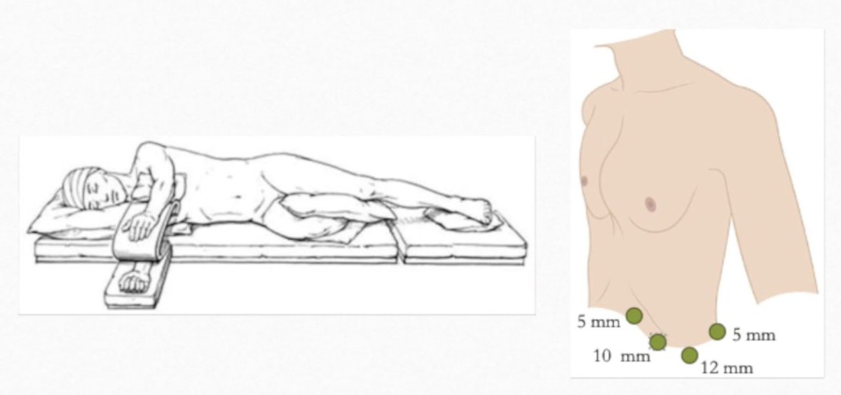 AnnSurgOncol's tweet image. Featured: Laparoscopic Subtotal #Splenectomy : A Feasible Option in the Treatment of #SplenicMetastasis . 

ow.ly/7zM350WyQIy

@nedamini
@SyedAAhmad5