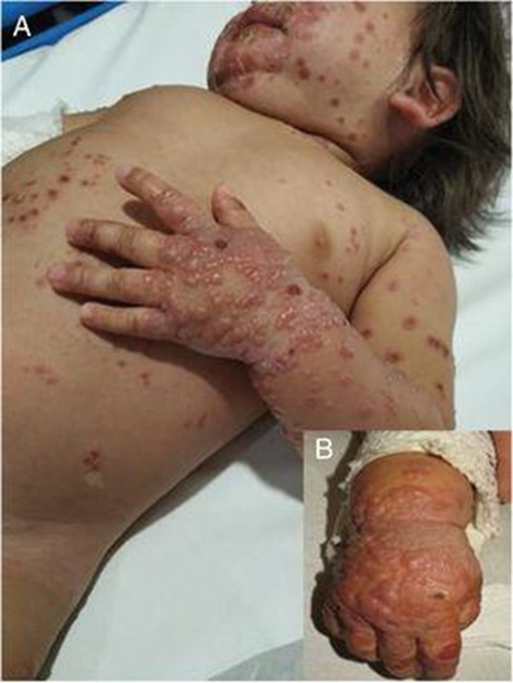 guerreroespejo's tweet photo. 16 meses , dermatitis atópica: erupción vesículo-ampollosa, con agrupación distal (1, 2), formando placas con edema, con vesiculación y costra central; peribucal y nasal (3) y erosiones en área del pañal.
1/2

DOI: 10.1016/j.anpedi.2020.10.012
#pediatria #Medicina https://t.co/3oojLttng9