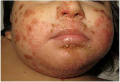 guerreroespejo's tweet photo. 16 meses , dermatitis atópica: erupción vesículo-ampollosa, con agrupación distal (1, 2), formando placas con edema, con vesiculación y costra central; peribucal y nasal (3) y erosiones en área del pañal.
1/2

DOI: 10.1016/j.anpedi.2020.10.012
#pediatria #Medicina https://t.co/3oojLttng9