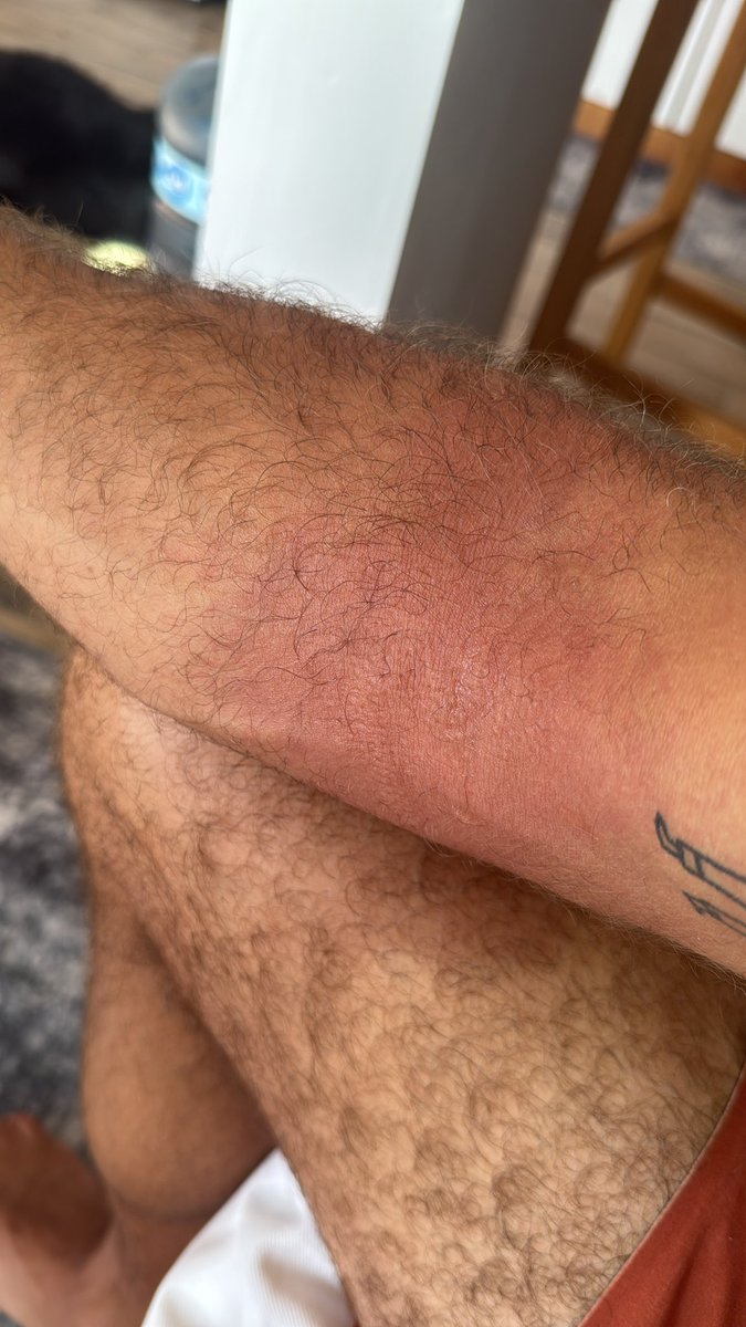 Got a nasty jelly fish sting while surfing this morning, whole arm went numb.