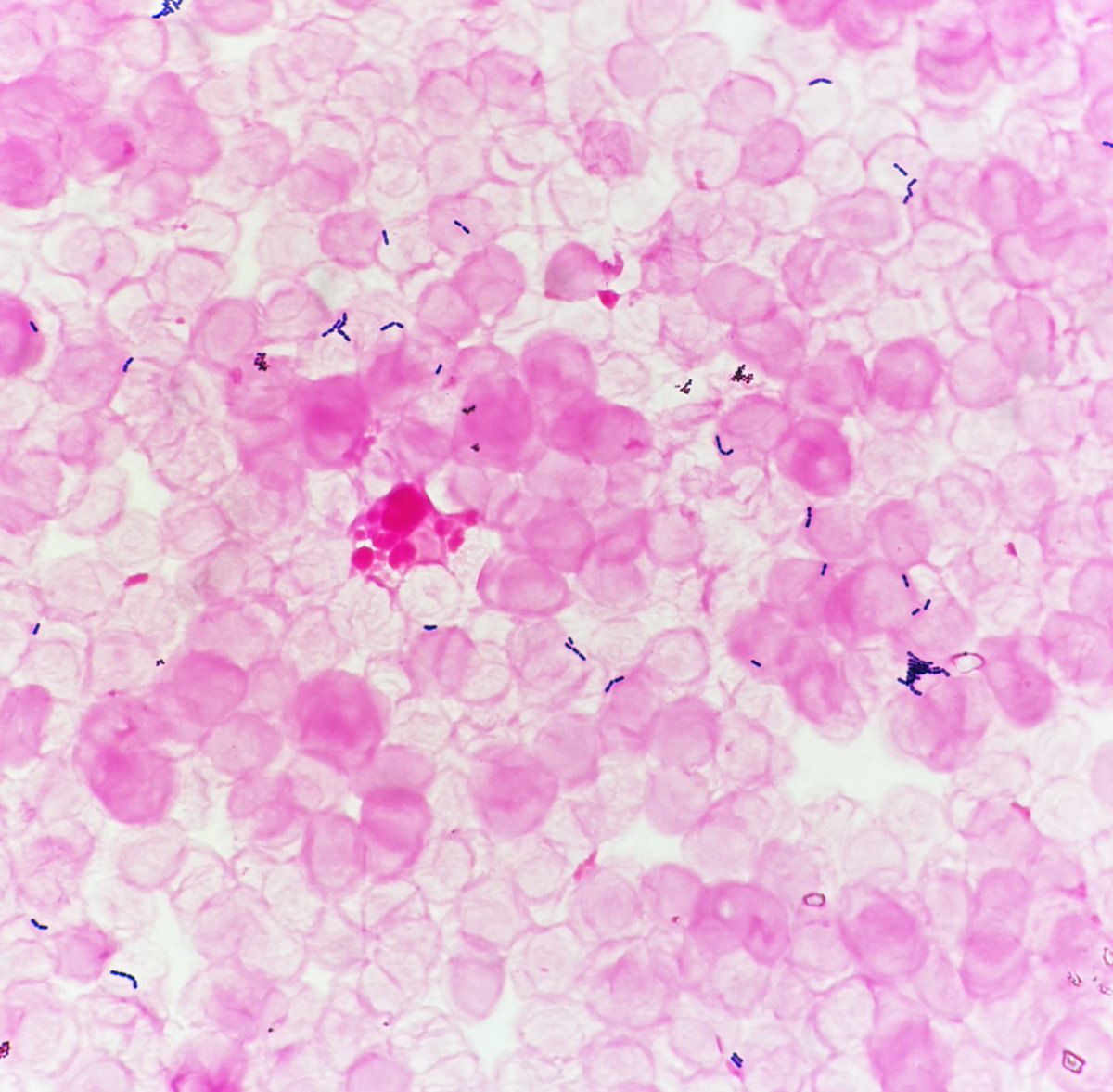candyca88328815's tweet photo. S. mutans 血液培養  塗沫はGPR様に見える. 粘着性glucanを多量に作り歯等の平滑面に他細菌とBiofilmを形成する. 感染性心内膜炎主要原因菌の一つ. 血清型はc,e,f,kに分類. f,k型はcollagen結合蛋白+,血管内皮細胞へ高い付着侵入能,fibrinogenを介し血小板凝集を誘導,ラットIEモデルに疣腫を形成した. https://t.co/tOROrPAbbK