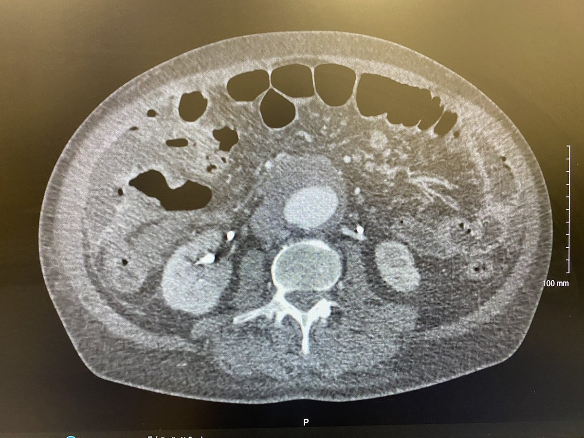 Looking for advice on #AortaEd 
62/M, good health, laparotomy for perf appendix. Incidental 7cm AAA with conical neck and multiple accessory renals. When and how should I go about repairing the aneurysm? 
<a href="/farkomd/">frank arko</a> <a href="/XavierBerardMD/">Xavier Berard</a> <a href="/ahmedkayssi/">Ahmed Kayssi</a>