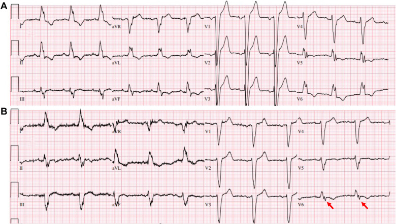 First and Second Degree Left Bundle Branch Block and Masquerading Bundle Branch Block: Lessons Learned During Conduction System Pacing #OpenAccess 

<a href="/BengtHerweg/">Bengt Herweg</a> 

heartrhythmjournal.com/article/S1547-…
