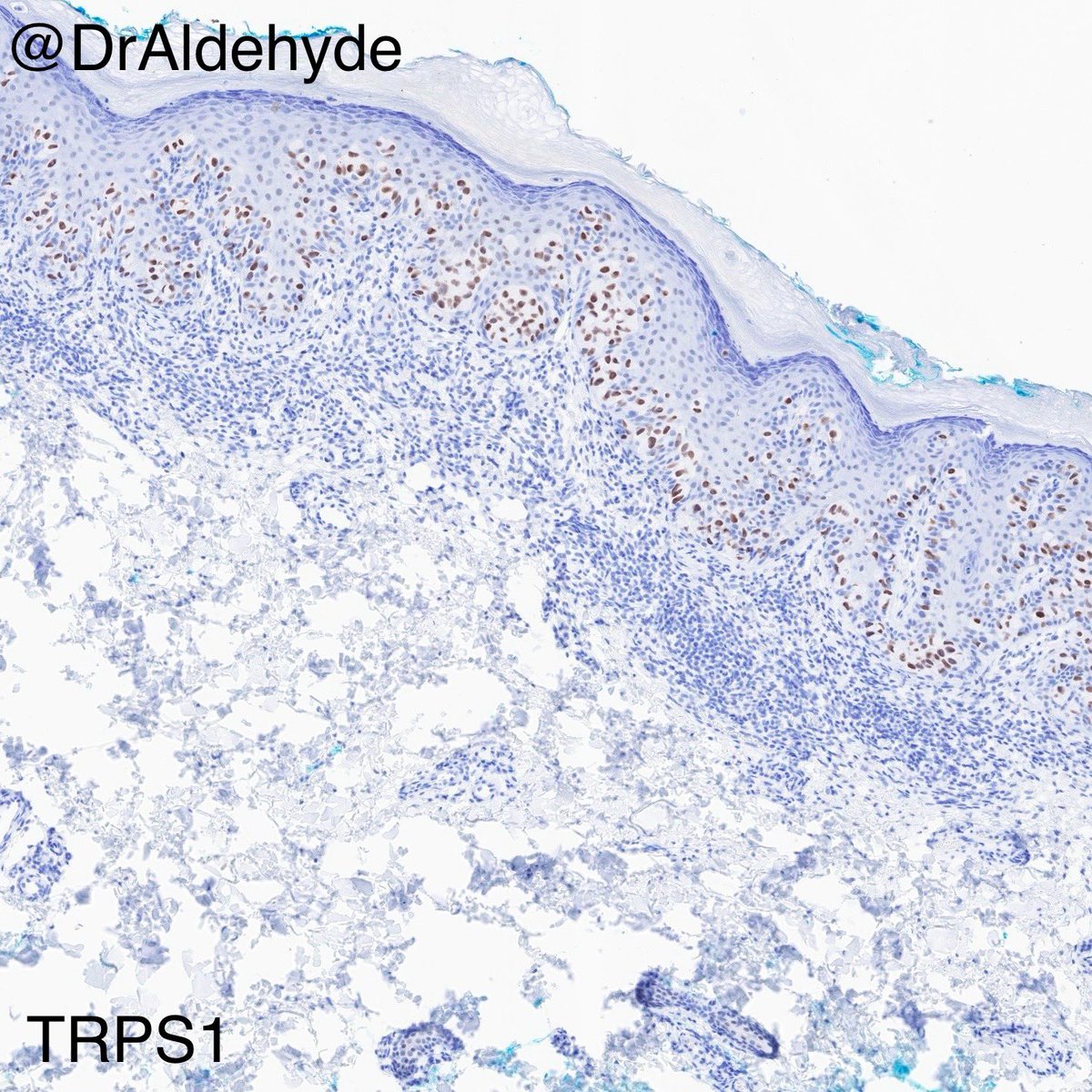 It’s been a while since I shared a case.

Did you know this immunoprofile, especially the diffuse TRPS1 immunoreactivity, strongly favors primary EMPD over secondary EMPD? Give it a try if you haven’t used it in your practice. 😆🔬

#dermpath #IHCPath #MDACCPath