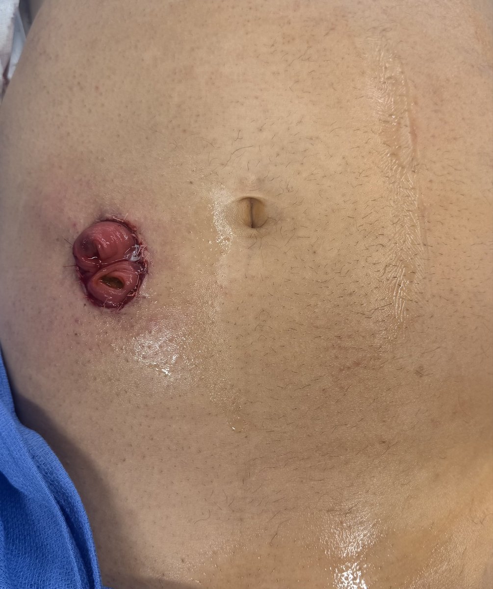 We’re continuing to expand the use of SP at <a href="/HMHNewJersey/">Hackensack Meridian</a>. Dr. Moore @doctorryanmoore successfully performed a no-incision LAR with coloanal anastomosis — one of the first cases in the country, and the first of its kind in New Jersey. Excellent outcome — more to come! Pt’s apr.