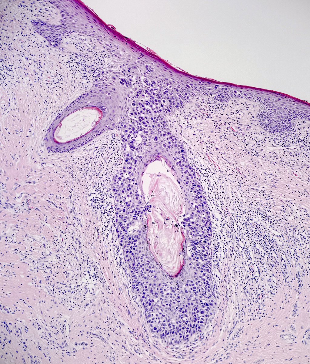 A nice case to share this evening.
#PagetDisease of the #nipple with colonisation of a subareolar duct. Spot the malignant cells bursting into the duct lumen.
#pathology
#BreastPath 
Wishing everyone a happy Wednesday.
💜