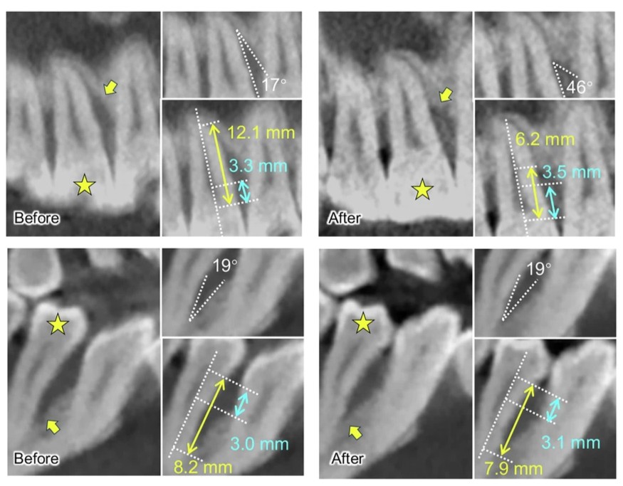 Researchers from Capital Medical University developed a human dental pulp stem cell injection to promote periodontal regeneration through a non-invasive procedure. 💉

🦷 Read their findings: go.nature.com/45C7UYh