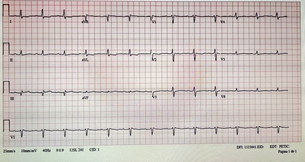 Out of hospital cardiac arrest and recurrent VF in ICU. Normal echo. Any thoughts? #CardioTwitter #Cardio #Cardiology #ECG #CVD