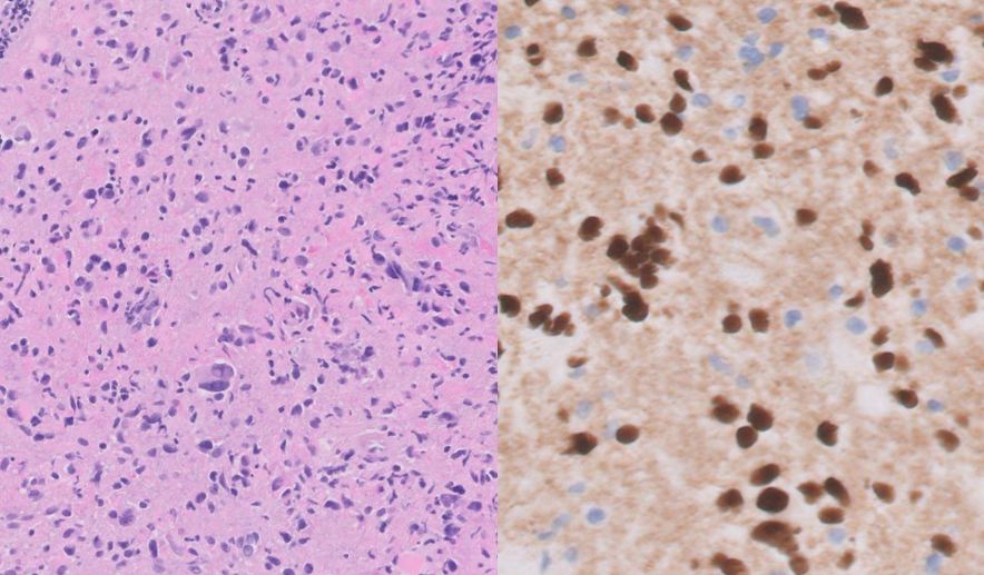 New FDA-approved targeted therapy: Dordaviprone in H3 K27M-mutant diffuse midline glioma fda.gov/drugs/resource…