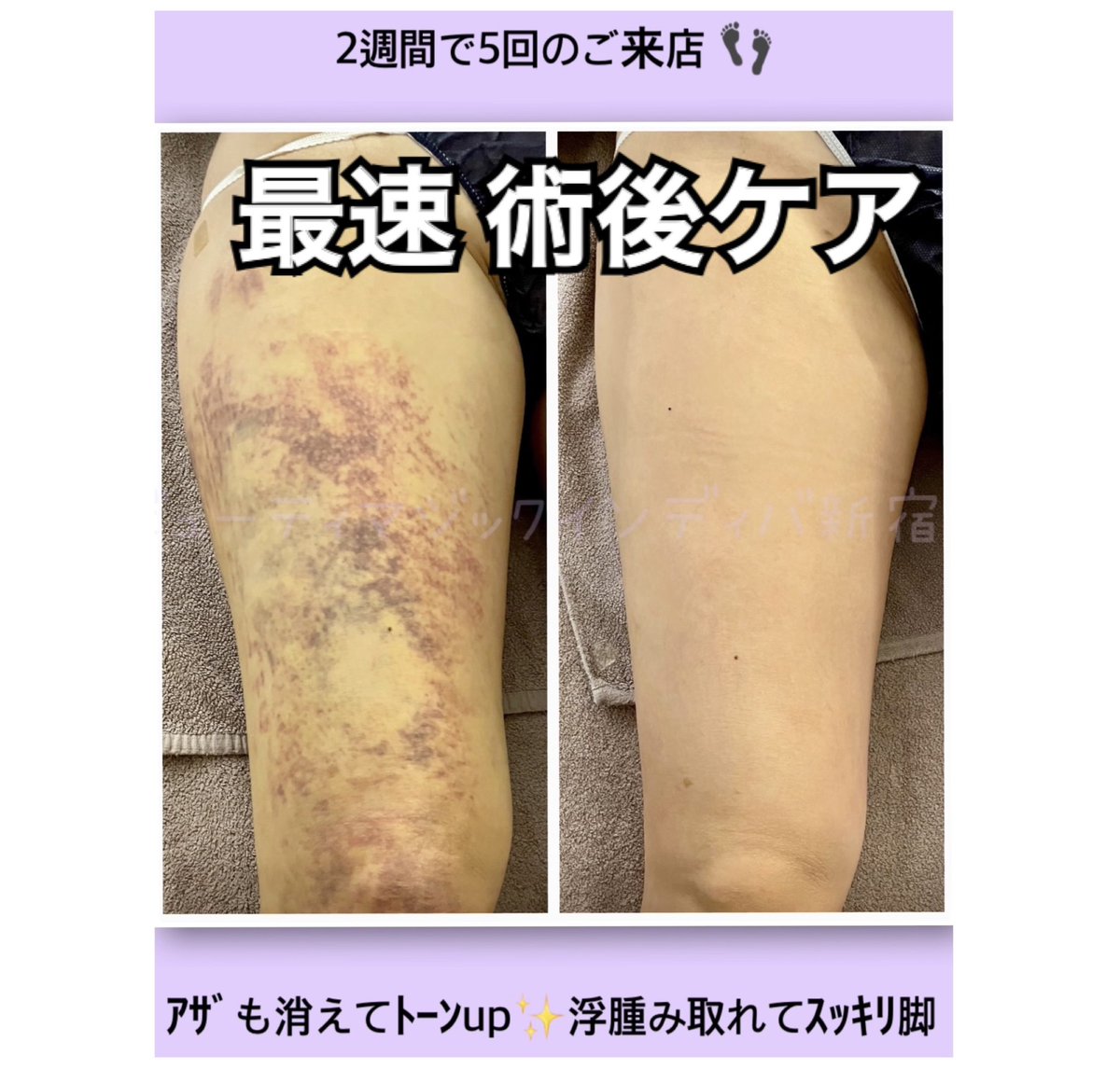 INDIBASHINJUKU's tweet photo. 【整形バレ防止👀】
脂肪吸引の内出血…こんなに消える！？
たった2週間で5回‼️
術後インディバでこの変化⚡️
夏のダウンタイム、最速で終わらせよう🔥

ビューティマジック本店

#術後ケア #脂肪吸引 #インディバ #ダウンタイム軽減 #整形垢さんと繋がりたい https://t.co/dcgl3NBTSO