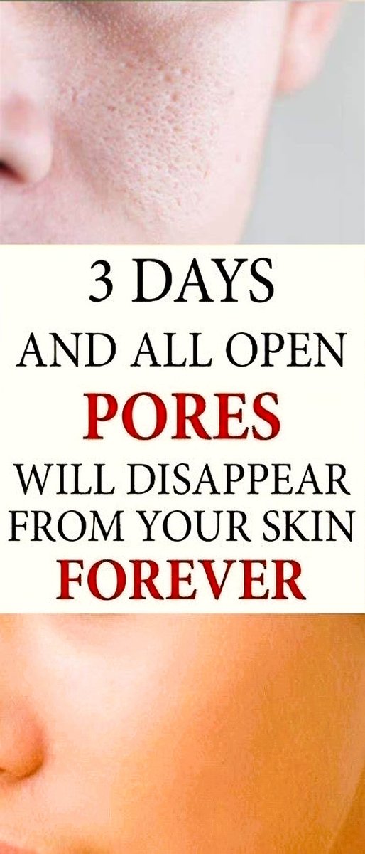 Healthy_Mgz's tweet image. ✨ Want smoother, refined skin? Say goodbye to open pores in just 3 days—with simple, natural remedies!

👇 Here&apos;s how it works : 
healthmgz.com/2022/09/3-days…

#PoreMinimizer #NaturalSkincare  #BeautyRoutine #GlowySkin #DIYFaceMask #ClearSkinTips #SkinCareHacks  #BeautyDIY