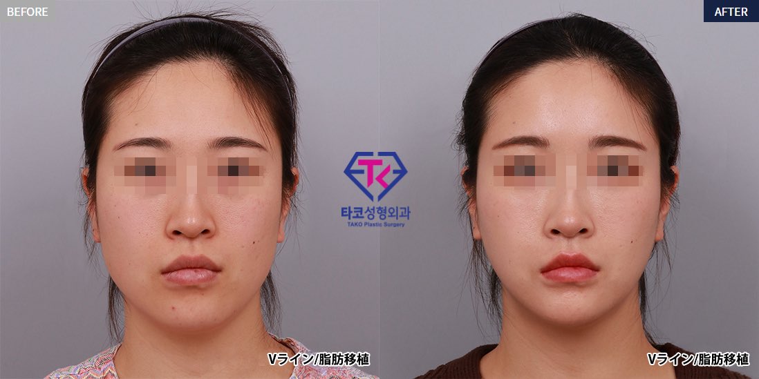 顔の美容外科手術 ZX-CLINIC【公式】｜大阪梅田・北新地からすぐの安くて承認機