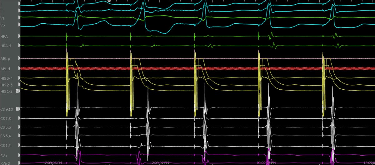 🧵Cool Para-Hisian maneuver from our AVNRT case today! What are we capturing on 1st beat, 2nd beat, and 3rd beat of this #EGM tracing?

a) His + V capture
b) Pure His capture
c) Pure ventricular capture

#Epeeps #Medtwitter