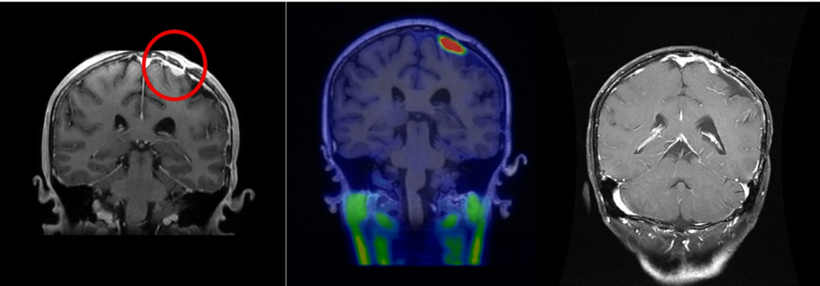 Boron Neutron capture for recurrent meningiomas.  Check out the latest study in the Journal of Neuro-Oncology by Lan and colleagues