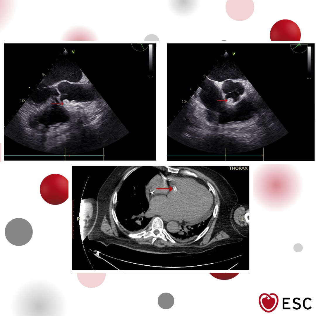 escardio's tweet image. #ImageOfTheWeek by Grigoris Avdikos, Dimitris Kourasis and Spiros Papaioannou from Athens Navy and Veterans Hospital, Athens, Greece.
A 68-year-old man with atrial flutter had TEE before cardioversion; an unexpected aortic mass was found. 

What’s your diagnosis?…