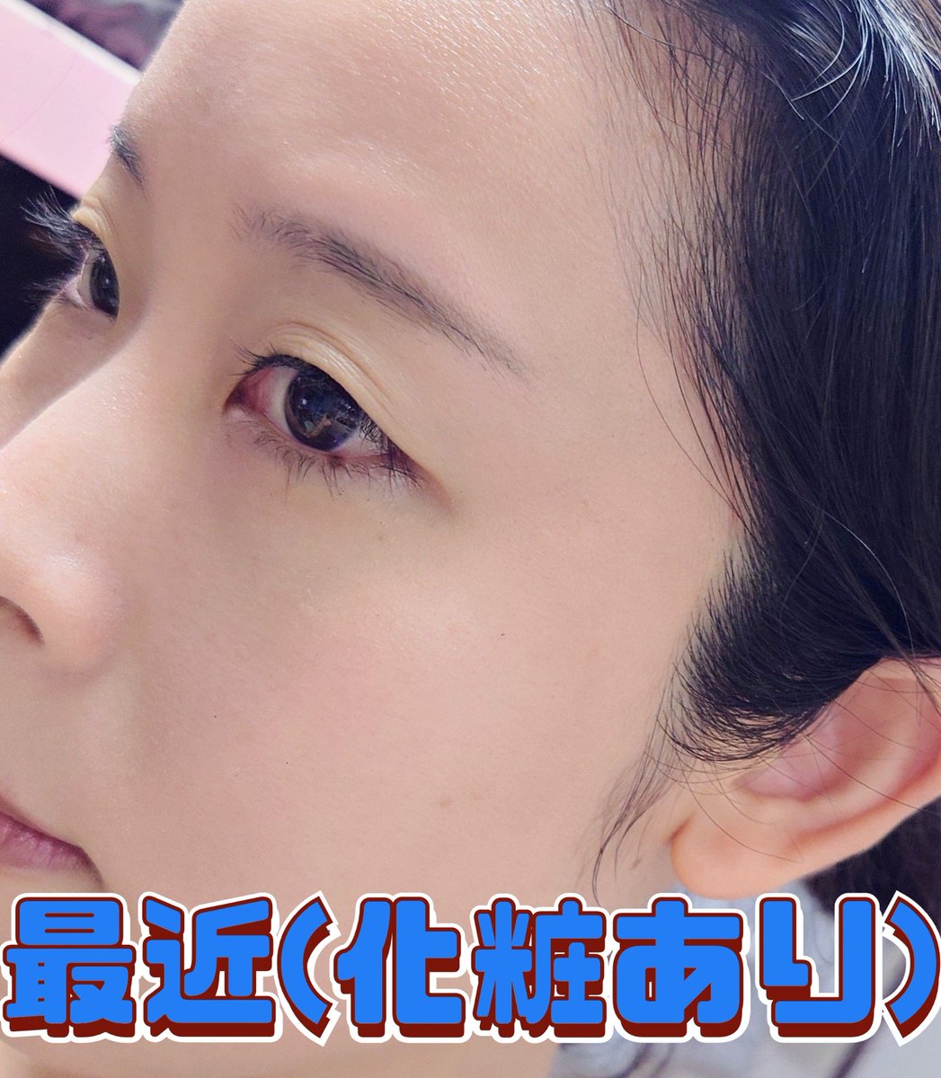 本当に汚い顔すぎて申し訳ないんですけど(というのが謙遜じゃない珍しい例)
最近、病的な乾燥肌が結構改善してきたから見て✨😭✨
いろんなことやりすぎて混乱してるけど、これはほんま効いたってこと近々まとめたい🥹

乾燥肌っていう言葉使うのが失礼なくらい汚い肌と顔