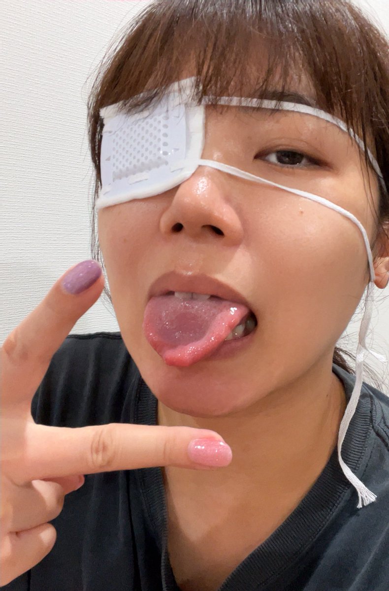 あれからモリモリと腫れました💣

『お岩さんみたい』っと言われる、、、誰？！😅
（怪談に出てくる人だっけ？？）

ものもらいの目薬と眼帯を頂きまして今に至ります。

僕は喰種だ😛笑

#東京喰種 #ものもらい #眼帯