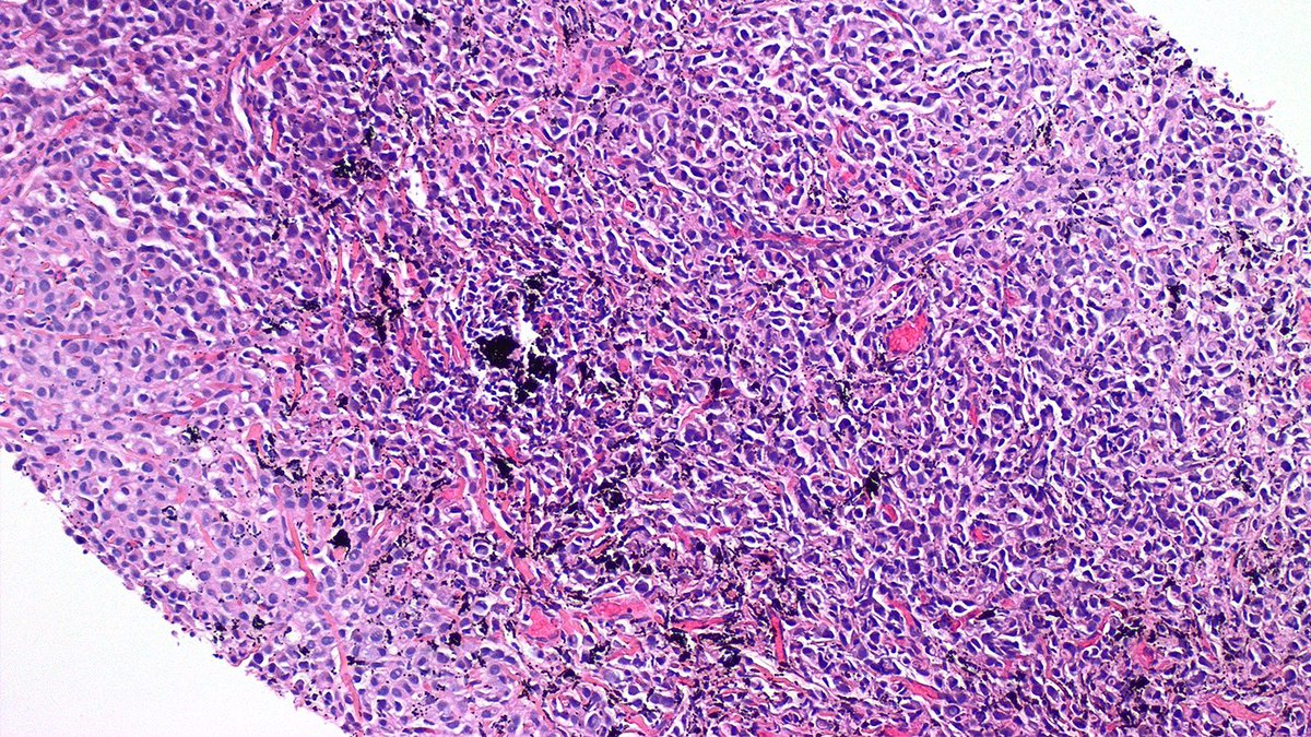 Case of Metastatic Carcinoma and Tattoo Pigment 🔬

Never stop looking once you’ve identified one finding! In this nodal biopsy, tattoo pigment from the patient’s arm is eye-catching, but metastatic lobular carcinoma lurking in the background.

#PathX #PathTwitter #breastpath