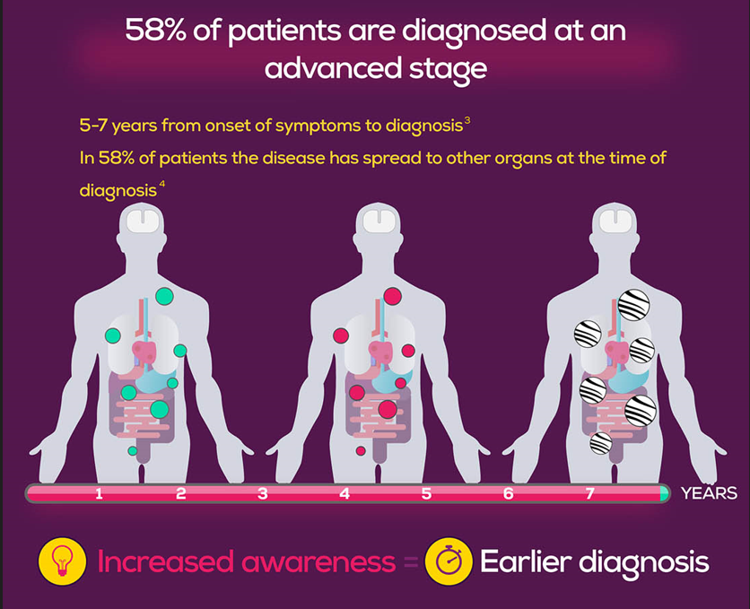 NET Cancer Day (@netcancerday) on Twitter photo Neuroendocrine neoplasms (NENs) are often misdiagnosed. Gastric and lung NETs are most common. 
✅We empower #generalpractitioners, #gastroenterologists and #pulmonologists with 26 #NETInfo factsheets in 12 languages: incalliance.org/net-info-packs/  #LetsTalkAboutNETs #MedTwitter Neuroendocrine neoplasms (NENs) are often misdiagnosed. Gastric and lung NETs are most common. 
✅We empower #generalpractitioners, #gastroenterologists and #pulmonologists with 26 #NETInfo factsheets in 12 languages: incalliance.org/net-info-packs/  #LetsTalkAboutNETs #MedTwitter
