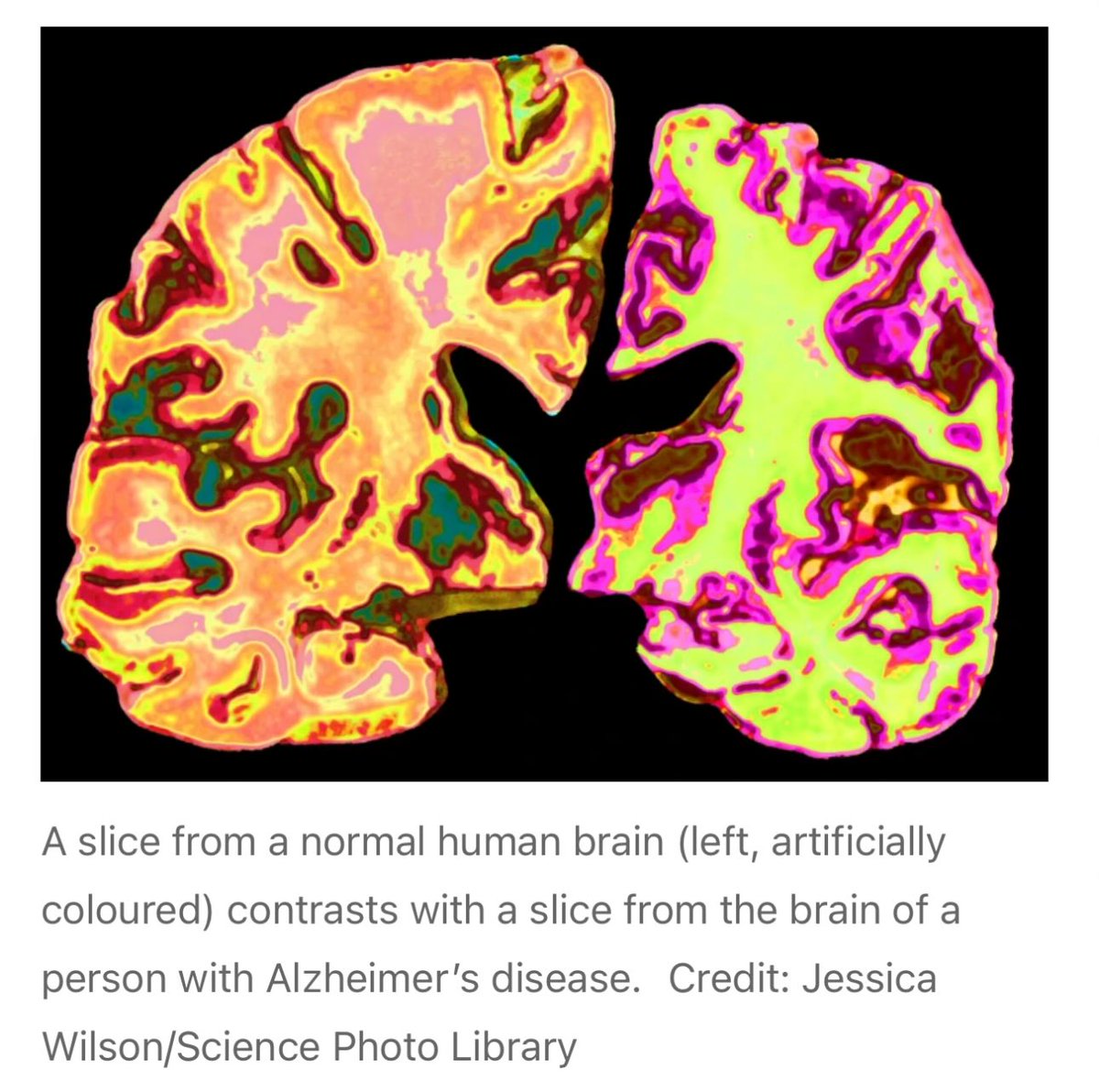 🧠💡 Alzheimer : une lueur d’espoir venue du lithium ?

Une étude parue dans <a href="/Nature/">nature</a> révèle un lien inattendu entre Alzheimer et un élément chimique bien connu : le lithium.

➡️ En analysant des cerveaux humains et en testant sur des souris, les chercheurs ont découvert que :