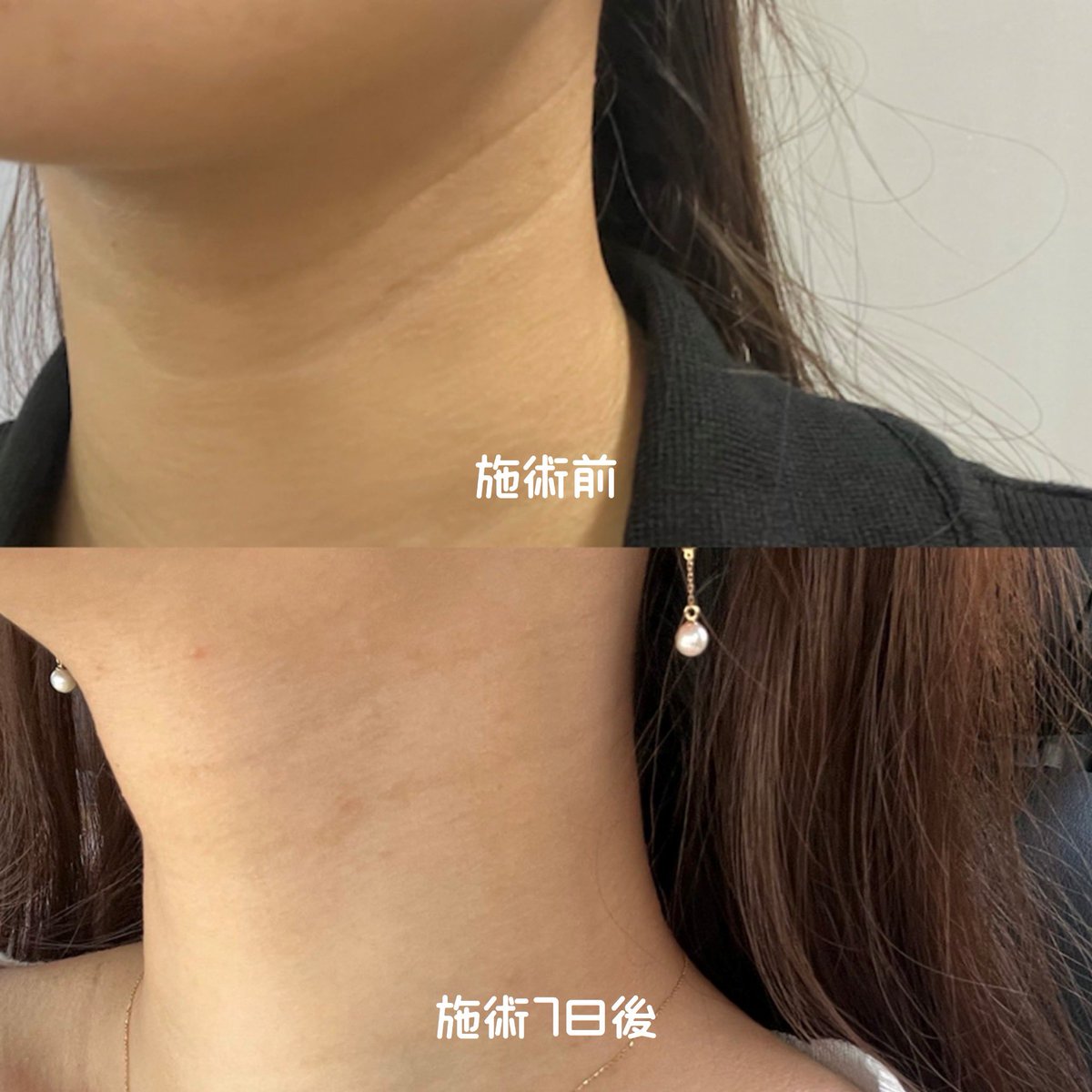 rosie 🩰 (@kinderplanet98) on Twitter photo オールライン(<a href="/All_lineJP/">ALL LINE CLINIC</a>)で首シワ予防施術「オールラインブースター3cc+ミラジェット」受けてきた!
首元って自分じゃケアしにくいし、いつも加工で消すくらいコンプレックスだったから、美容医療に頼れるのありがたいね🥹✨痛みにかなり敏感私でもこれは全然耐えられれた💛
金額は350,900ウォン! オールライン(<a href="/All_lineJP/">ALL LINE CLINIC</a>)で首シワ予防施術「オールラインブースター3cc+ミラジェット」受けてきた!
首元って自分じゃケアしにくいし、いつも加工で消すくらいコンプレックスだったから、美容医療に頼れるのありがたいね🥹✨痛みにかなり敏感私でもこれは全然耐えられれた💛
金額は350,900ウォン!