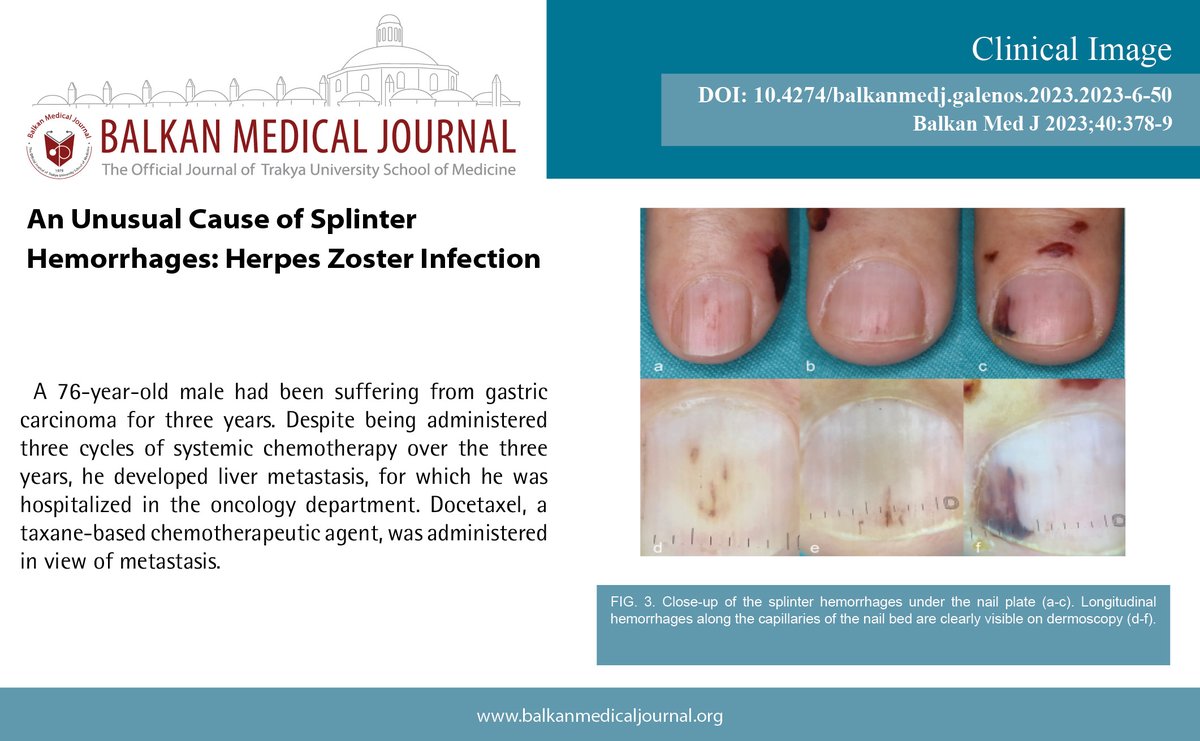 An Unusual Cause of Splinter Hemorrhages: Herpes Zoster Infection
You can see the free full text of the research by Ozan Erdem et al.
Link : balkanmedicaljournal.org/uploads/pdf/pd…