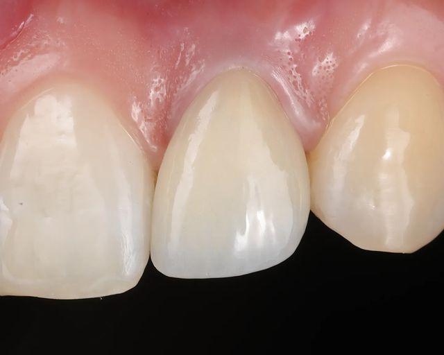 Double cementing strategy