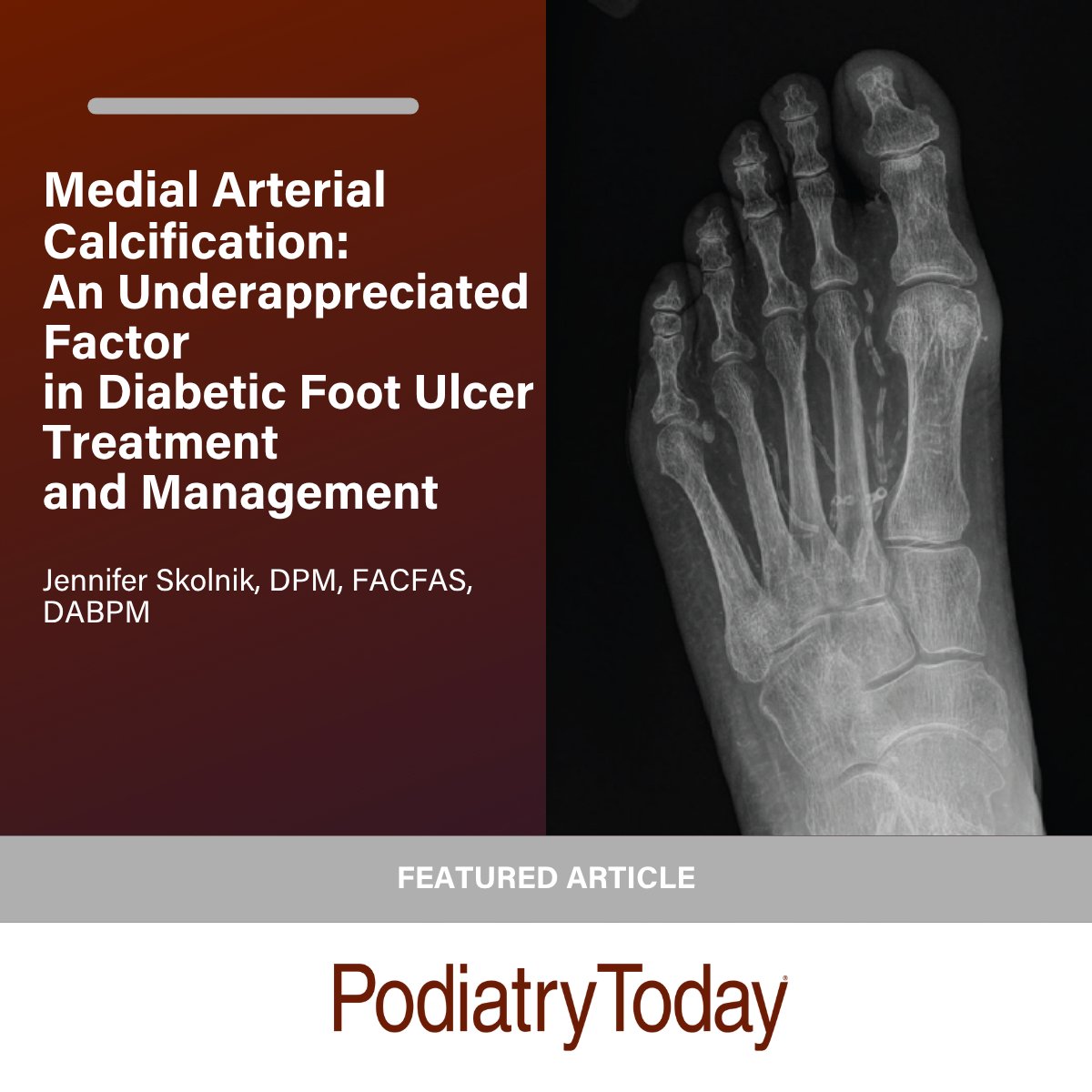 Don't miss this latest feature in Podiatry Today!
tinyurl.com/54rhvrrn
#MAC #DFU #DPM #podiatry
