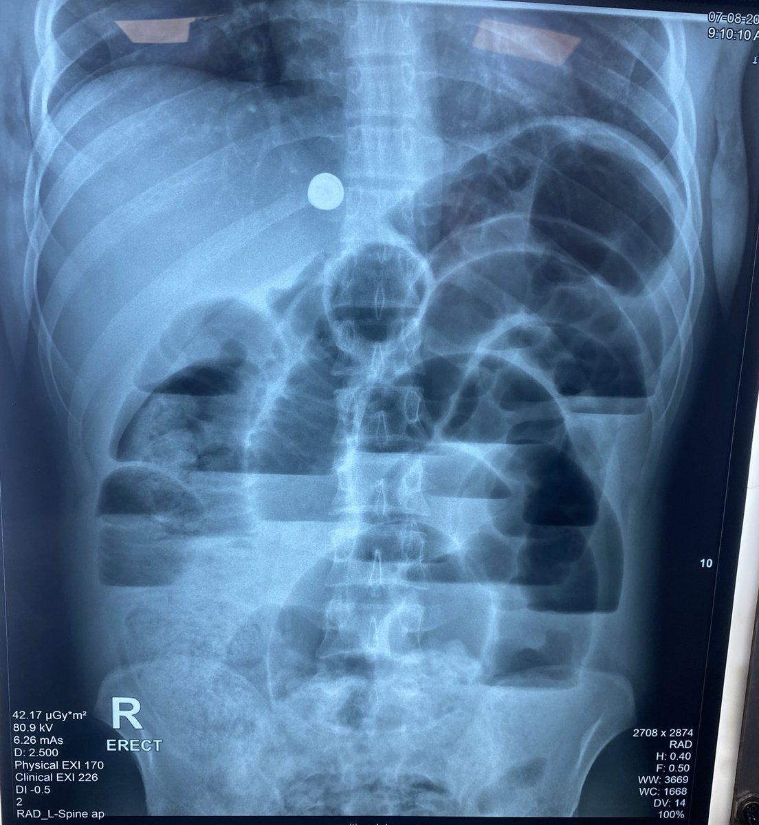 What is the radiological finding ?
What is the diagnosis ?

#MEDHM #MedX <a href="/IhabFathiSulima/">Dr Ihab Suliman</a>