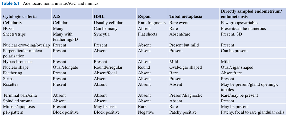 DrCycloPath's tweet photo. Answer for #2: Atypical endocervical cells 
Cells: sheets, strips, pseudostratified
Nuclei: enlarged, elongated, hyperchromatic with heterogeneous & coarse chromatin
Hyperchromasia that is more monotonous than simple metaplasia
Cytoplasm: may be abundant, but N:C is increased; distinct cell borders
#CytoPath #PathSky #PathTwitter #Pathology