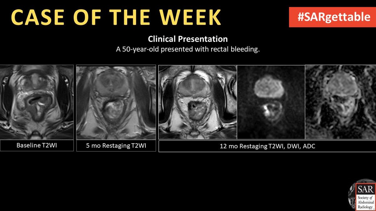 It's time for a new #SARGettable case of the week, contributed by Kevin Chang.

Comment your diagnosis below! 

#Radiology