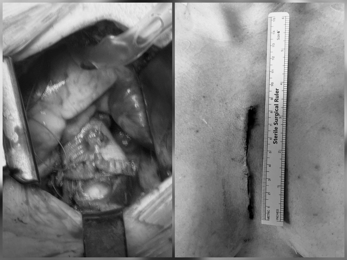 Performed a complex aortic valve replacement &amp; ascending aortic replacement (Wheat procedure) through an 8cm incision! 

This mini-upper hemisternotomy approach expands the limits of minimally invasive heart surgery, ensuring less pain and faster recovery for our young patient.