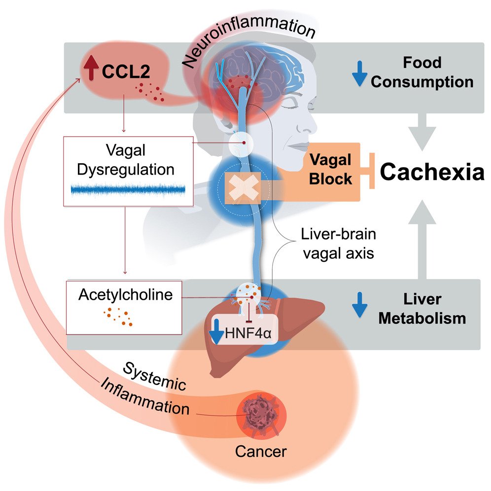 Anirban Maitra (@aiims1742) on Twitter photo Huge congratulations to Xiling Shen <a href="/MDAndersonNews/">MD Anderson Cancer Center</a> and <a href="/AyeletErez/">Ayelet Erez</a> <a href="/WeizmannScience/">Weizmann Institute</a> for their <a href="/CellCellPress/">Cell</a> paper:
Vagal blockade of the brain-liver axis deters cancer-associated cachexia
cell.com/cell/abstract/…
Clinical trials in patients with #PancreaticCancer forthcoming! Huge congratulations to Xiling Shen <a href="/MDAndersonNews/">MD Anderson Cancer Center</a> and <a href="/AyeletErez/">Ayelet Erez</a> <a href="/WeizmannScience/">Weizmann Institute</a> for their <a href="/CellCellPress/">Cell</a> paper:
Vagal blockade of the brain-liver axis deters cancer-associated cachexia
cell.com/cell/abstract/…
Clinical trials in patients with #PancreaticCancer forthcoming!