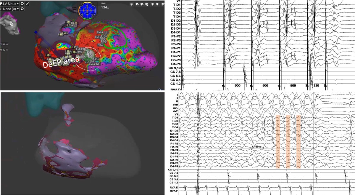 Konstantinos Letsas (@k_letsas) on Twitter photo cMRI aided VT ablation with AFFERA system. Excellent correlation of DeEP mapping areas with cMRI corridors and easy termination. <a href="/SteliosDragasis/">Stelios</a> <a href="/ipetemil/">Panagiotis Mililis</a> <a href="/Kariki_O/">Ourania Kariki</a> <a href="/athsaplaouras/">Athanasios Saplaouras</a> @A_martinos @stavrinakoskina <a href="/PetrosSkalidis/">Petros Skalidis</a> <a href="/eva_nyktari/">Eva Nyktari</a> <a href="/MEfraimidis/">Michail Efremidis</a> <a href="/Medtronic/">Medtronic</a> <a href="/EPeeps/">e__peeps</a> cMRI aided VT ablation with AFFERA system. Excellent correlation of DeEP mapping areas with cMRI corridors and easy termination. <a href="/SteliosDragasis/">Stelios</a> <a href="/ipetemil/">Panagiotis Mililis</a> <a href="/Kariki_O/">Ourania Kariki</a> <a href="/athsaplaouras/">Athanasios Saplaouras</a> @A_martinos @stavrinakoskina <a href="/PetrosSkalidis/">Petros Skalidis</a> <a href="/eva_nyktari/">Eva Nyktari</a> <a href="/MEfraimidis/">Michail Efremidis</a> <a href="/Medtronic/">Medtronic</a> <a href="/EPeeps/">e__peeps</a>