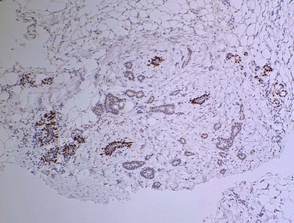 Thursday education day! A deceptive #BreastCarcinoma 
#TubularCarcinoma 
Well formed, single layered tubules.
CK5, SMMHC and p63 very helpful with internal neighbourhood controls positive.
Hope that everyone is doing well today.
💜