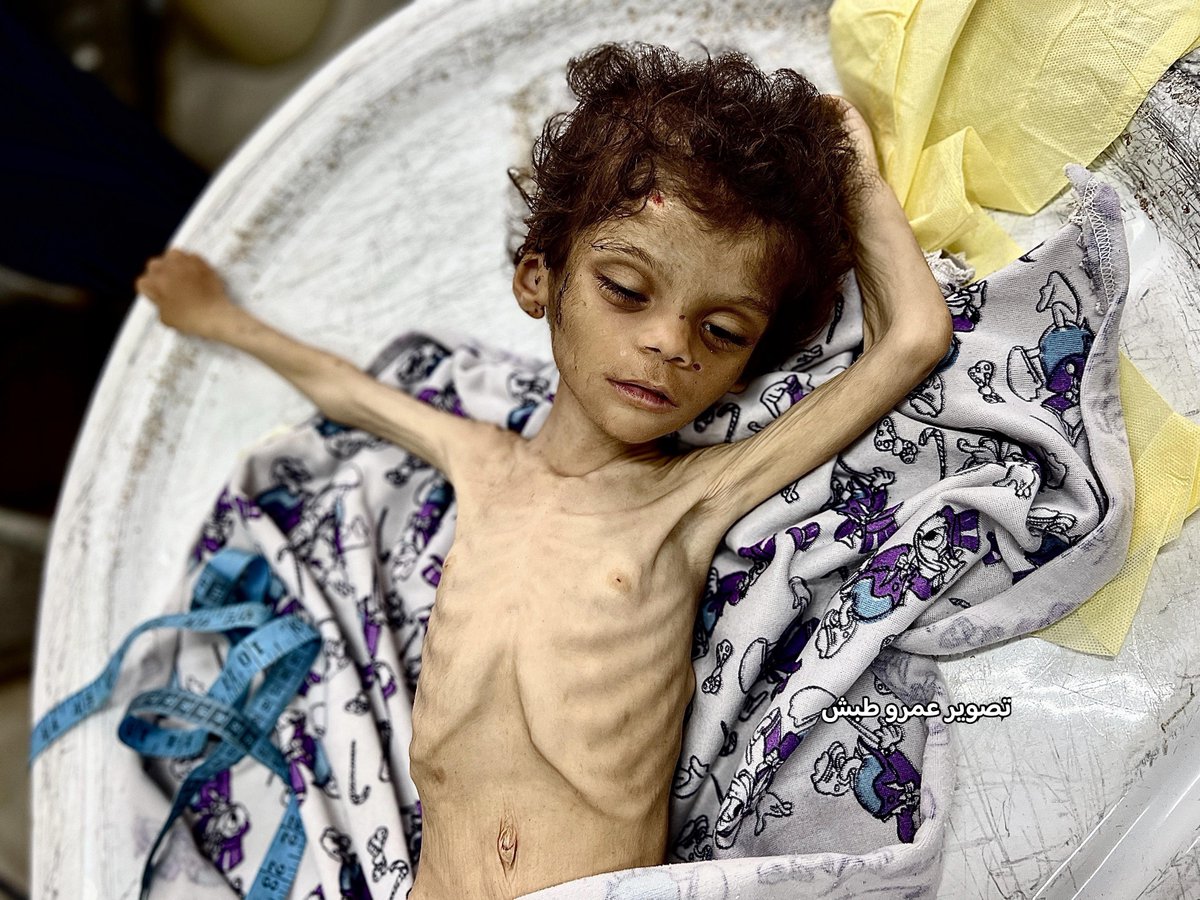 توفيت اليوم الطفلة رؤى الماشي نتيجة الجوع الشديد وسوء التغذية الحاد، وعن عمر يناهز عامين ونصف، 

والغريب هذه المرة، أن الطفلة الجميلة رؤى توفيت في خيمة أهلها في منطقة مواصي خانيونس، ولا نعلم هل كان السبب اكتظاظ المستشفيات بالجرحى ومرضى الجوع وسوء التغذية أم فقدان أهلها الأمل