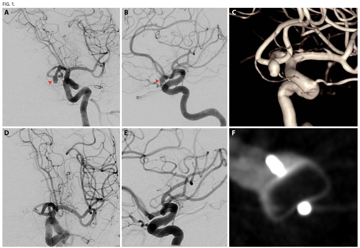 Journal of Neurosurgery (@thejns) on Twitter photo #JNSCaseLessons. Researchers highlight microsurgical clipping as favorable retreatment strategy for aneurysmal recurrence following WEB embolization. 
thejns.org/caselessons/vi… #JNSCaseLessons. Researchers highlight microsurgical clipping as favorable retreatment strategy for aneurysmal recurrence following WEB embolization. 
thejns.org/caselessons/vi…