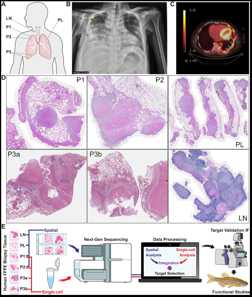 mbiojournal's tweet image. Paired scRNA-seq and spatial #transcriptomics from human #tuberculosis granulomas uncovers a central role for osteopontin-expressing macrophages in TB. @denniskoHiHOST doi.org/10.1128/mbio.0…