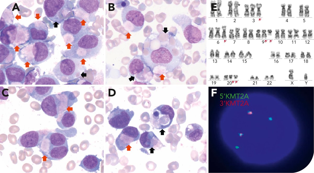 Atypical cytoplasmic inclusions and erythrophagocytosis in acute myeloid leukemia with KMT2A::MLLT3 and U2AF1 mutation ashpublications.org/blood/article/…