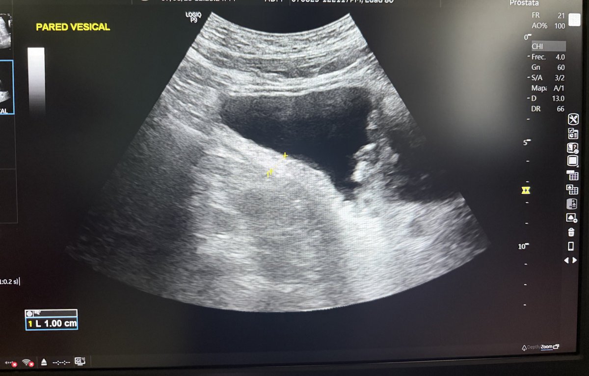 Otra #vejiga de esfuerzo 😔 

Este daño se puede prevenir con tratamiento médico o cirugía 🍊

La próstata se puede operar a cualquier edad, la vejiga no.

#HoLEP 

<a href="/RomanCarvajal/">DR CARVAJAL</a> <a href="/lfredosanchez/">Alfredo Sanchez Urólogo</a> <a href="/felipeglezglez/">felipe gonzalez</a>